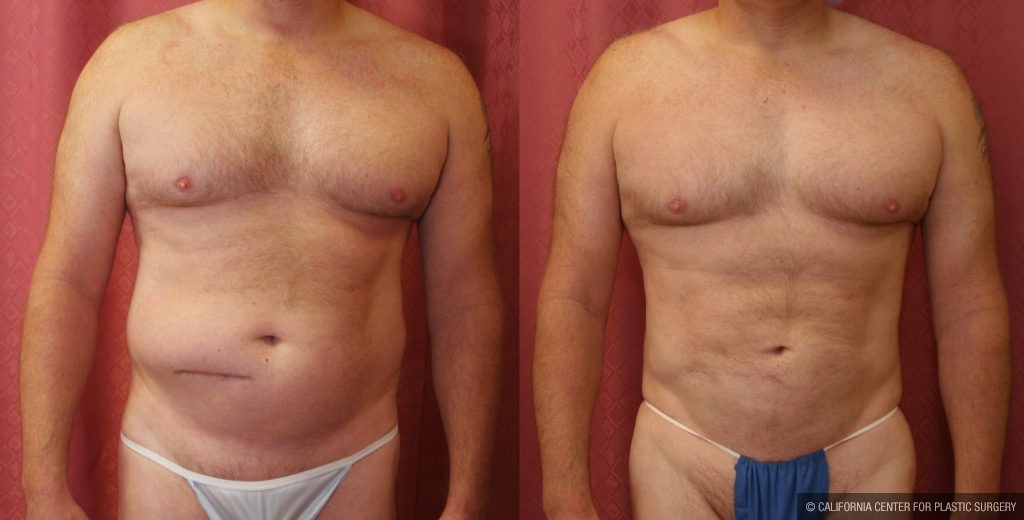 Male Liposuction Abdomen Before & After Patient #10279