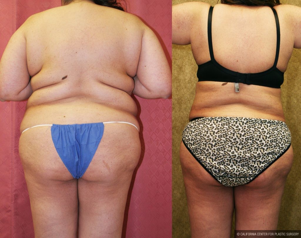 Body Contouring Before & After Patient #10282