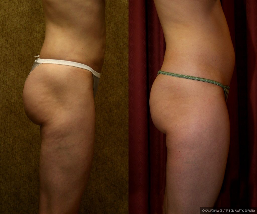 Body Contouring Before & After Patient #10332