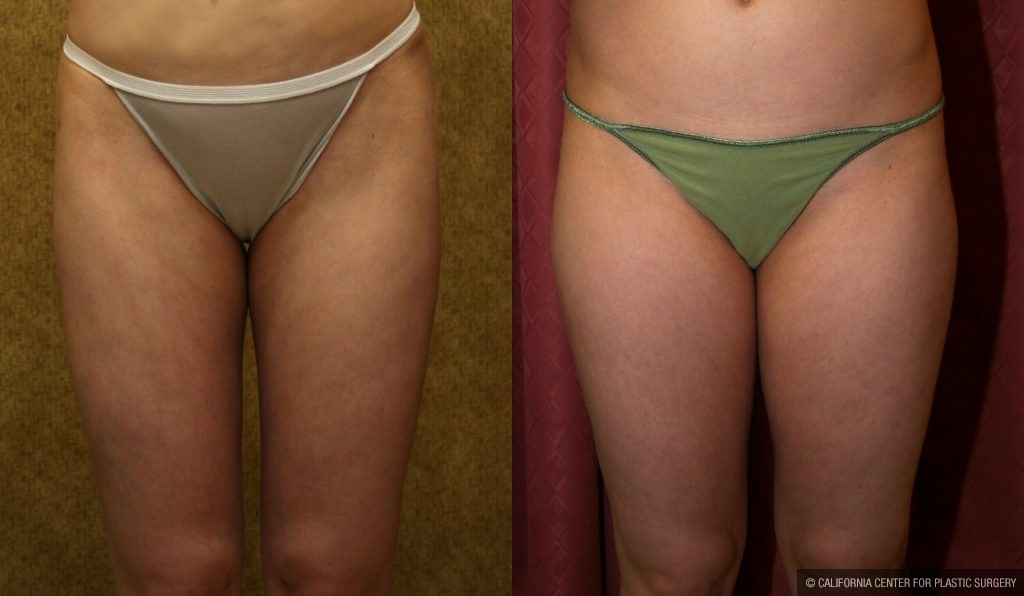 Body Contouring Before & After Patient #10332