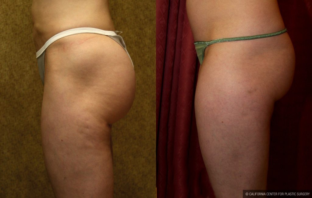 Body Contouring Before & After Patient #10332