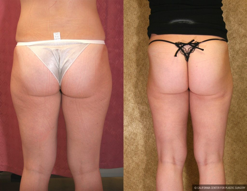 Body Contouring Before & After Patient #10327