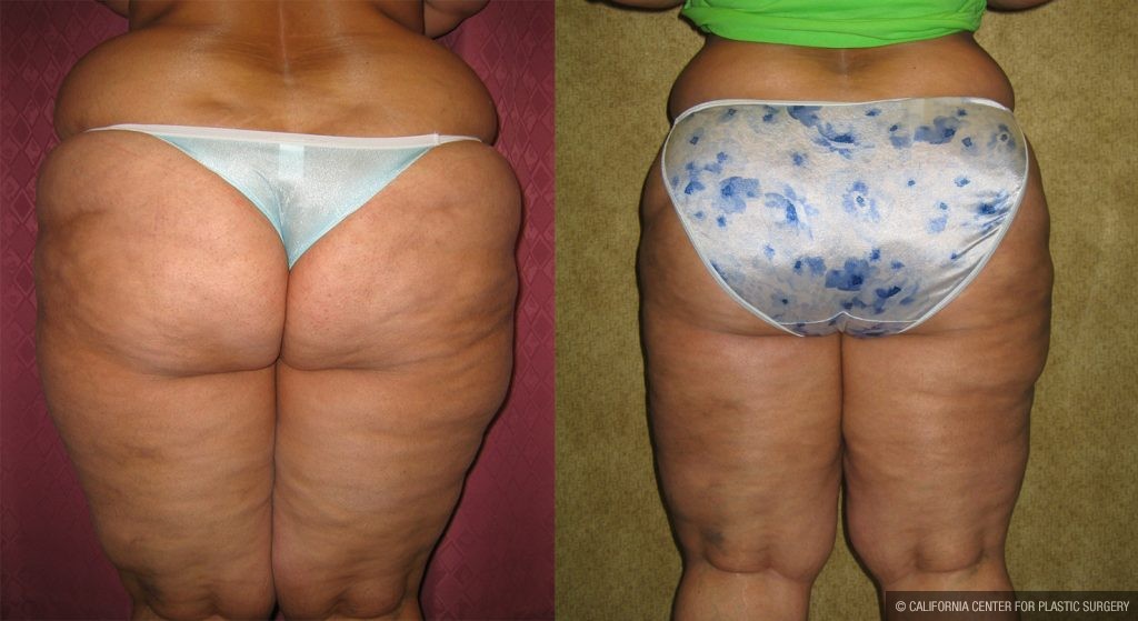 Body Contouring Before & After Patient #10339