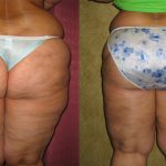 Body Contouring Before & After Patient #10339