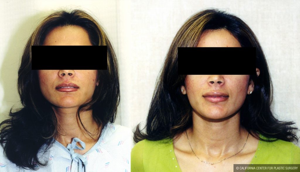 Facial Cosmetic Surgery Before & After Patient #10482