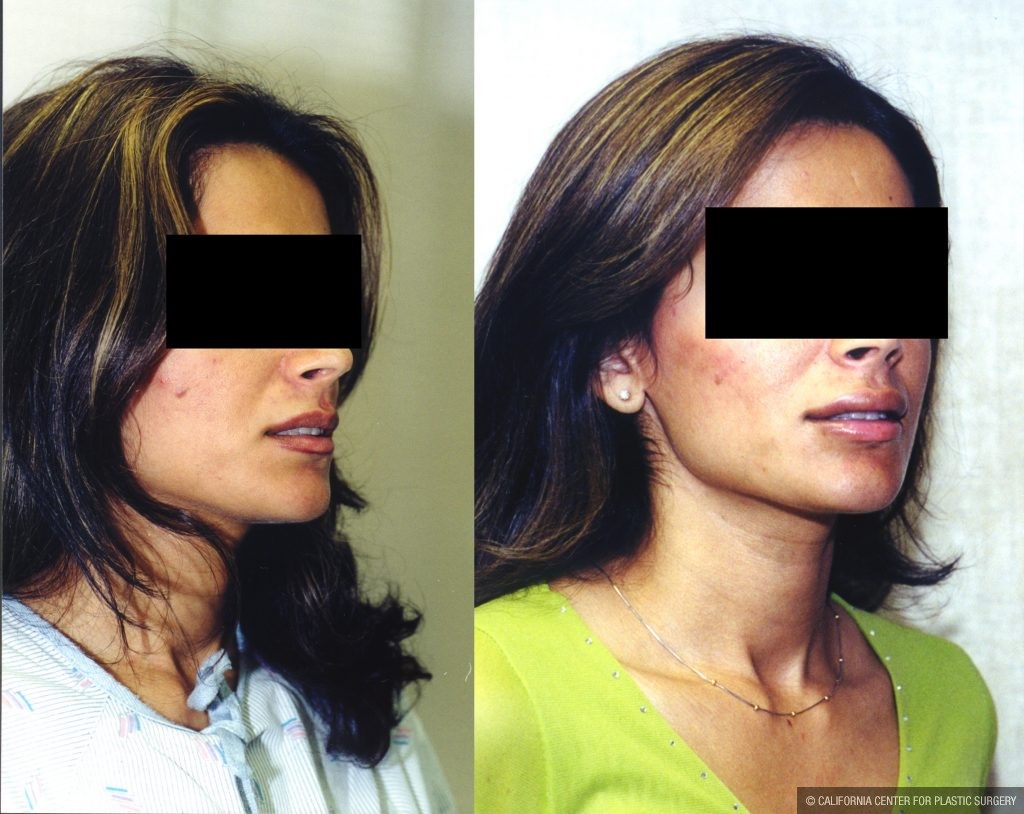 Facial Cosmetic Surgery Before & After Patient #10482