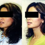 Facial Cosmetic Surgery Before & After Patient #10482