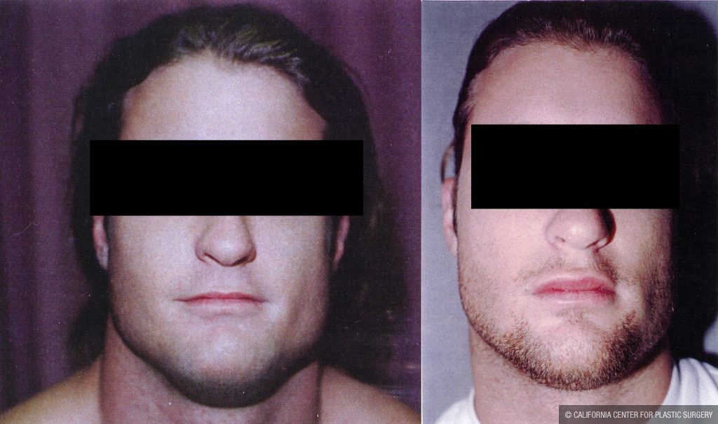 Facial Cosmetic Surgery Before & After Patient #10479