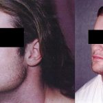 Facial Cosmetic Surgery Before & After Patient #10479