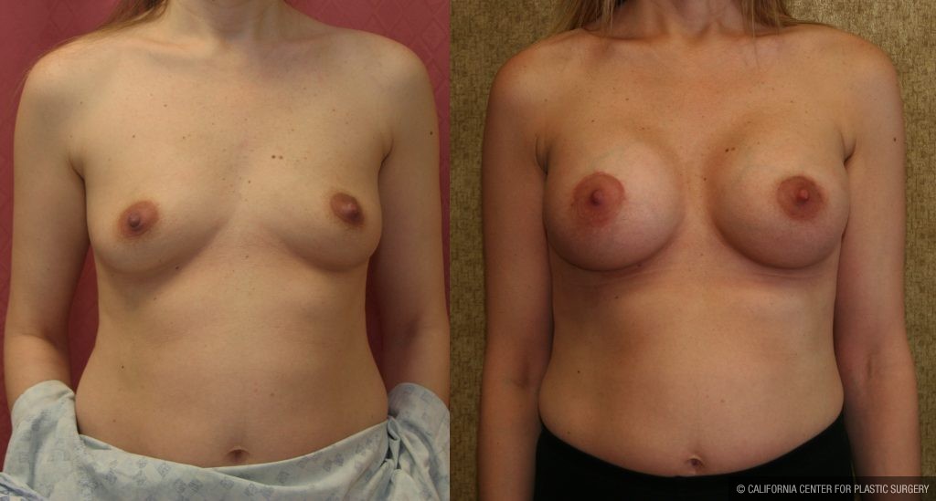 Breast Augmentation Before & After Patient #10795