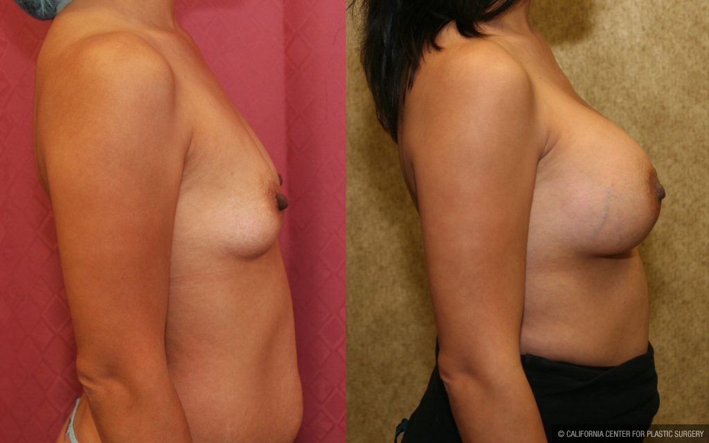 Breast Augmentation Before & After Patient #10812