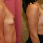 Breast Augmentation Before & After Patient #10812