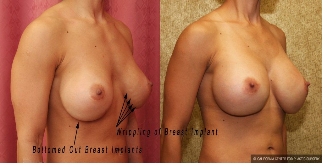 Breast Augmentation Before & After Patient #10816