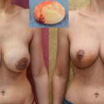 Breast Augmentation Before & After Patient #10822