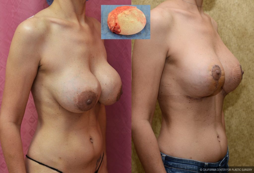 Breast Augmentation Before & After Patient #10822