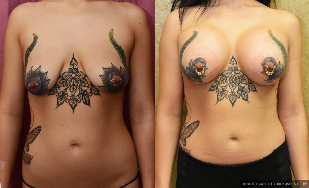 Breast Lift (Mastopexy) Before & After Patient #10835