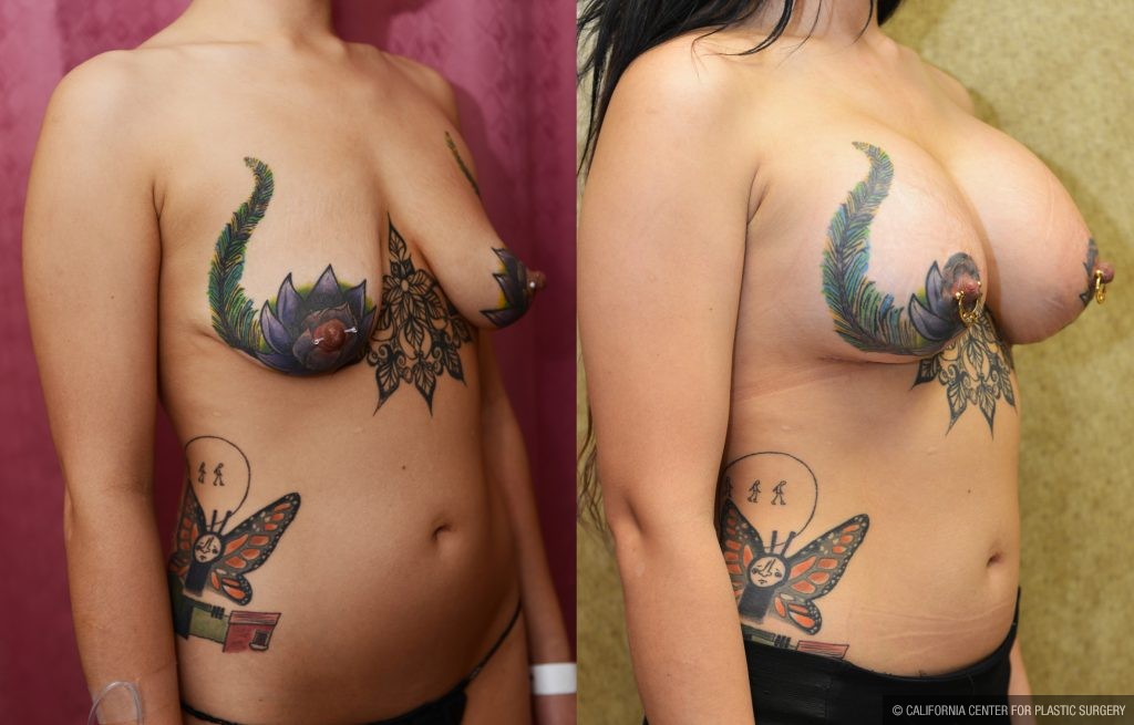 Breast Lift (Mastopexy) Before & After Patient #10835