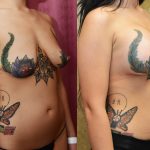 Breast Lift (Mastopexy) Before & After Patient #10835