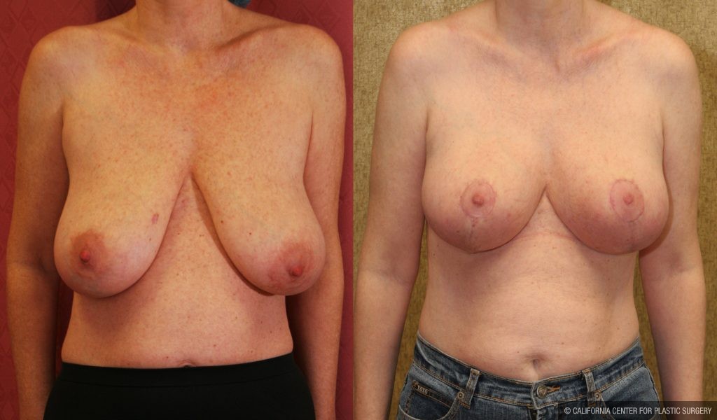 Breast Lift Before & After Patient #10826