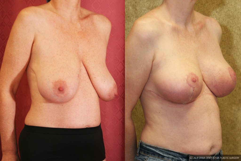 Breast Lift (Mastopexy) Before & After Patient #10826