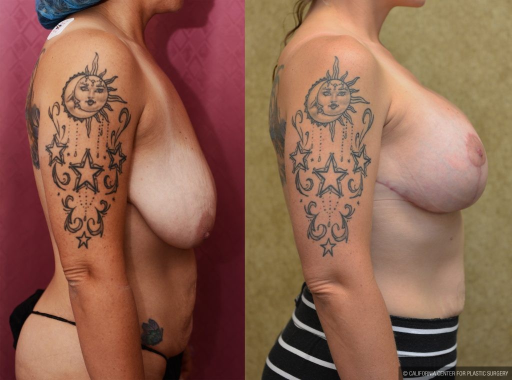 Breast Lift (Mastopexy) Before & After Patient #10831