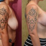 Breast Lift (Mastopexy) Before & After Patient #10831