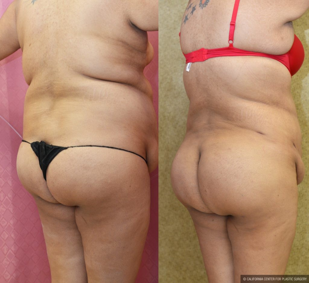 Buttock Lift/Augmentation Before & After Patient #10844