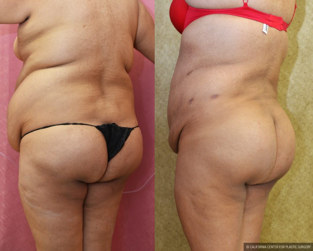 Buttock Lift/Augmentation Before & After Patient #10844