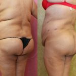 Buttock Lift/Augmentation Before & After Patient #10844