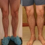 Calf Augmentation Before & After Patient #10877