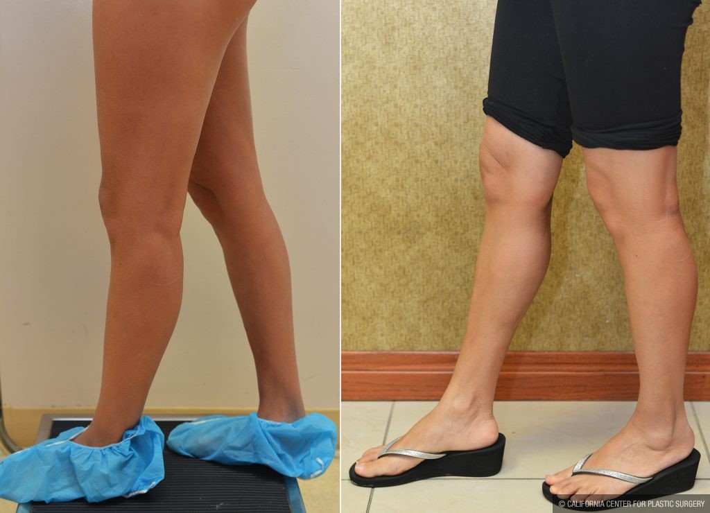 Calf Augmentation Before & After Patient #10906
