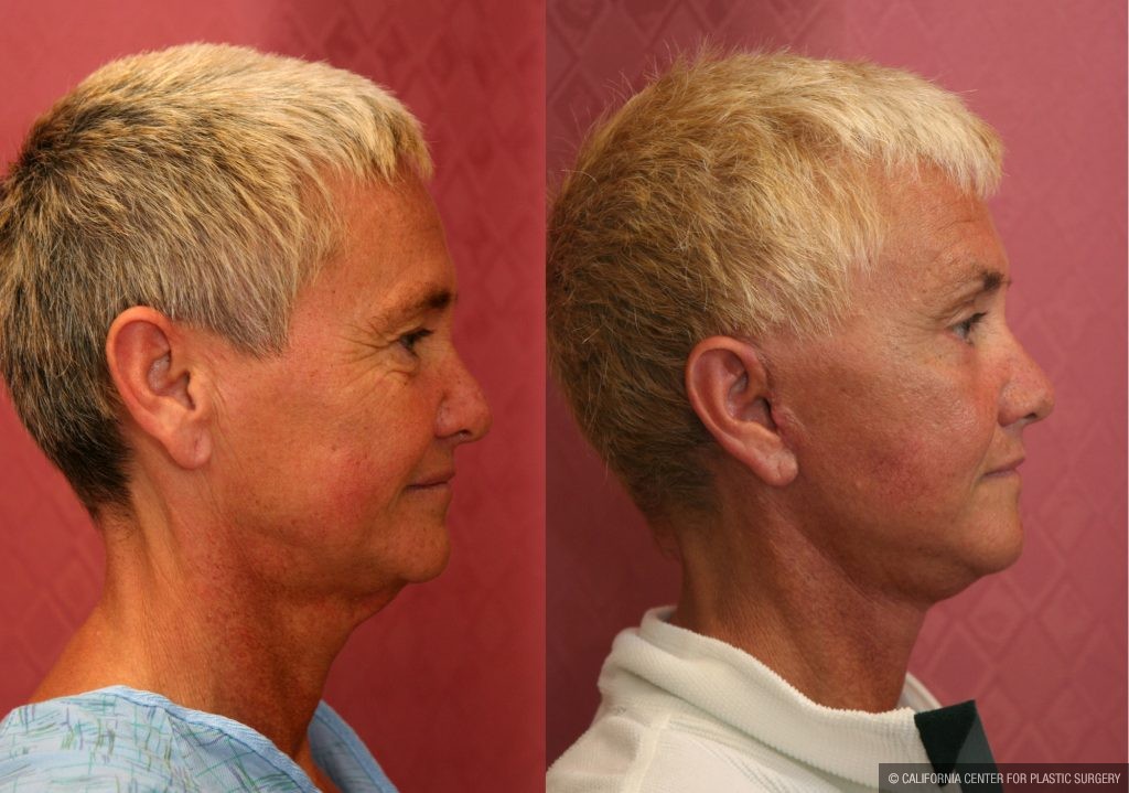 Facelift Before & After Patient #10940