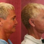 Facelift Before & After Patient #10940