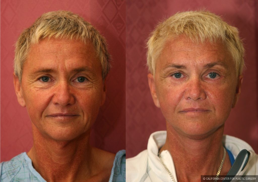 Mid-Facelift Before & After Patient #10940