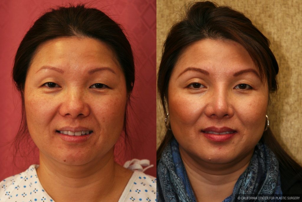 Rhinoplasty - Asian Before & After Patient #11009