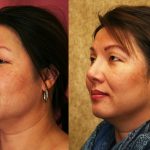 Rhinoplasty - Asian Before & After Patient #11009