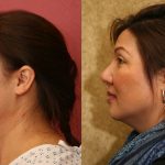 Rhinoplasty - Asian Before & After Patient #11009