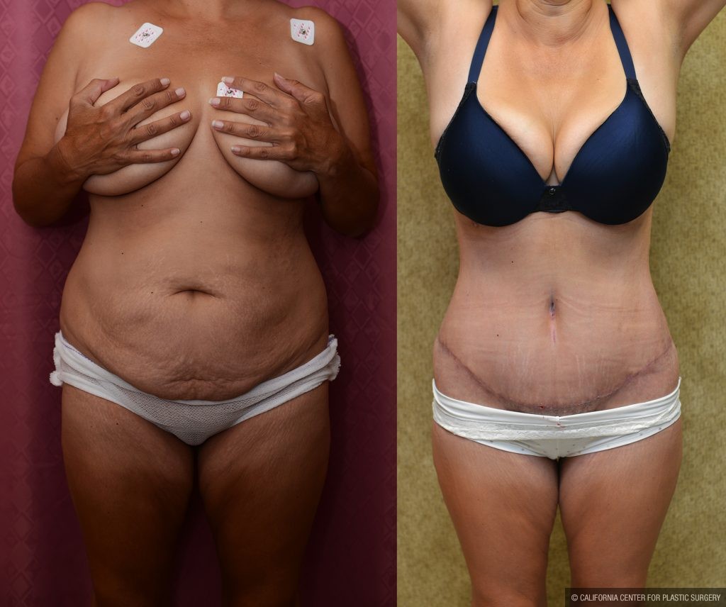 Tummy Tuck (Abdominoplasty) Medium Size Before & After Patient #11042