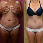 Tummy Tuck (Abdominoplasty) Medium Size Before & After Patient #11042