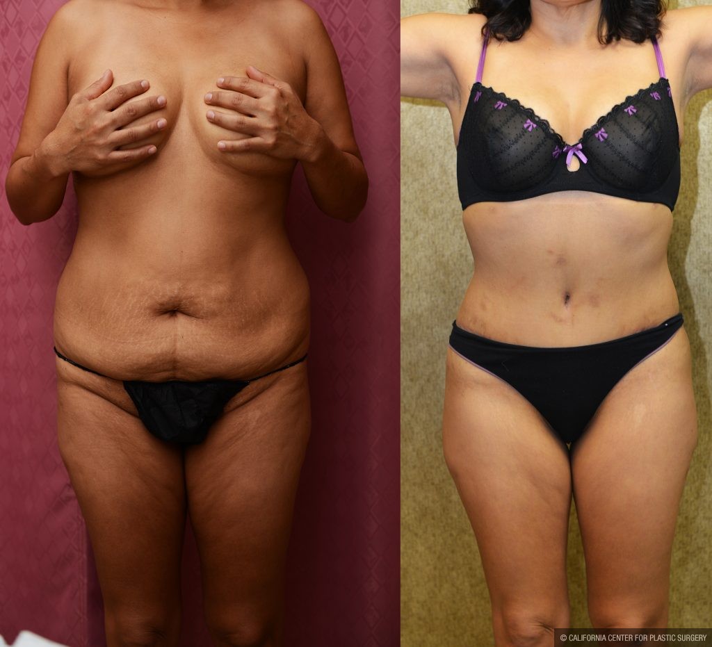 Tummy Tuck (Abdominoplasty) Small Size Before & After Patient #11056