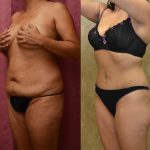 Tummy Tuck (Abdominoplasty) Small Size Before & After Patient #11056