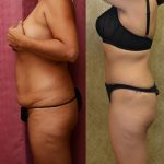 Tummy Tuck (Abdominoplasty) Small Size Before & After Patient #11056