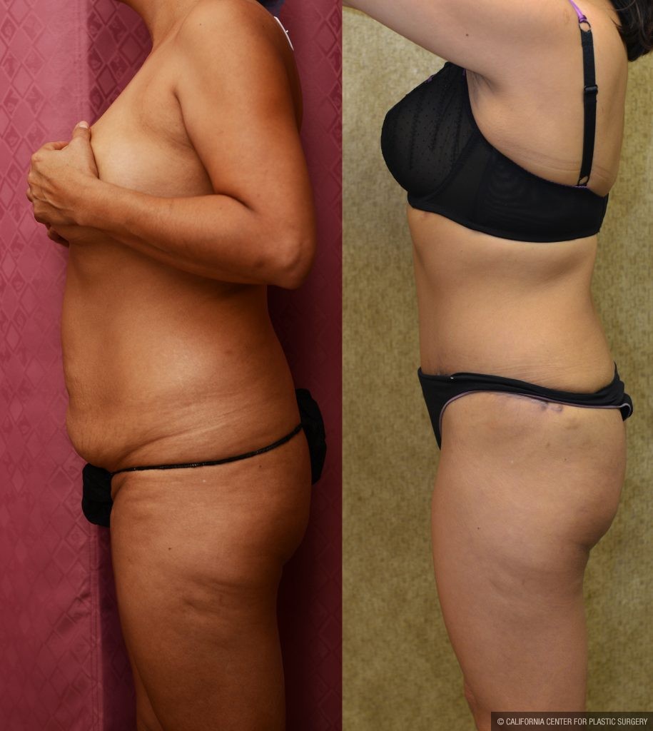 Tummy Tuck (Abdominoplasty) Small Size Before & After Patient #11056