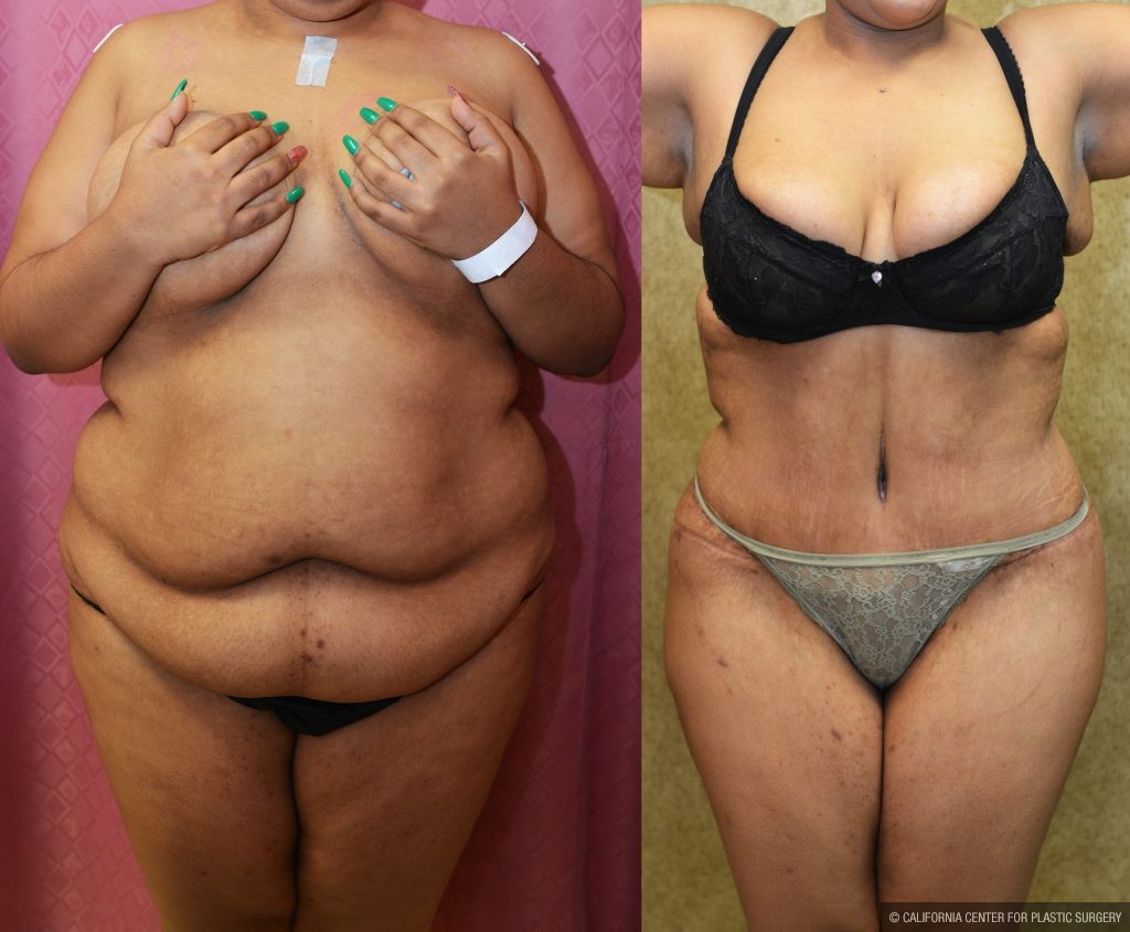 Tummy Tuck (Abdominoplasty) Plus Size Before & After Patient #11060