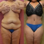 Tummy Tuck (Abdominoplasty) Plus Size Before & After Patient #11065