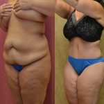 Tummy Tuck (Abdominoplasty) Plus Size Before & After Patient #11065