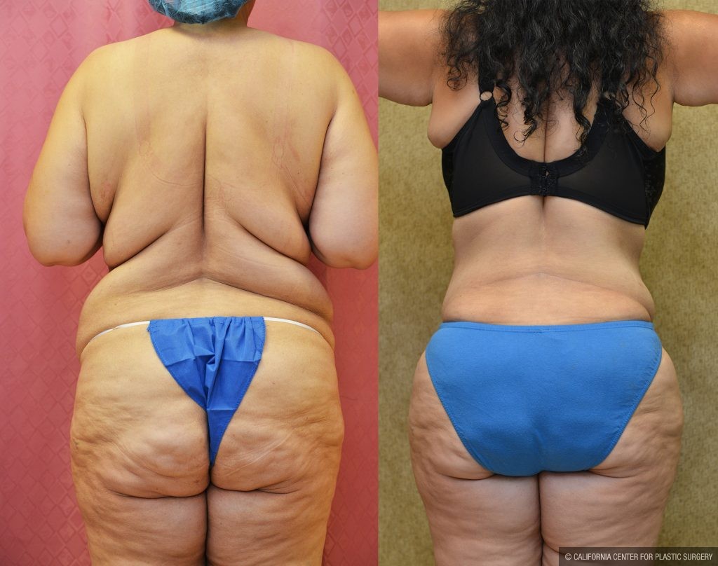 Tummy Tuck (Abdominoplasty) Plus Size Before & After Patient #11065