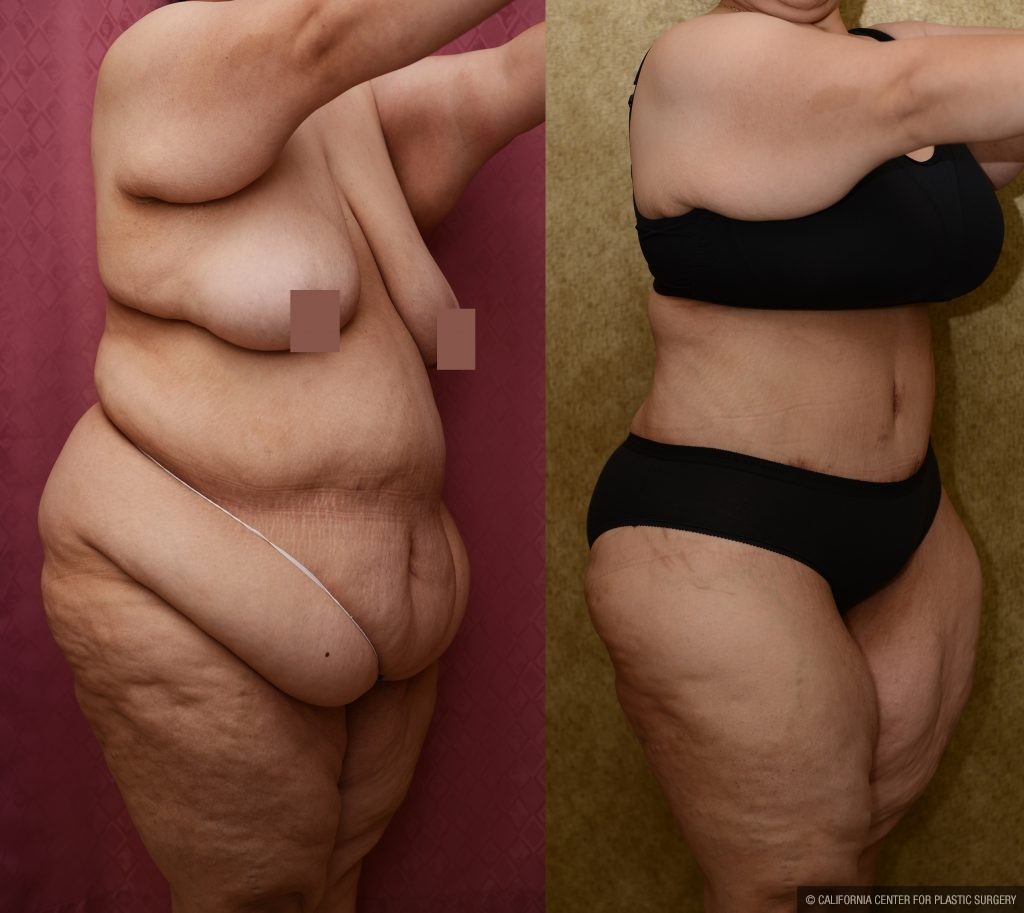 Patient #11070 Tummy Tuck (Abdominoplasty) Plus Size Before and