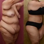 Tummy Tuck (Abdominoplasty) Plus Size Before & After Patient #11070