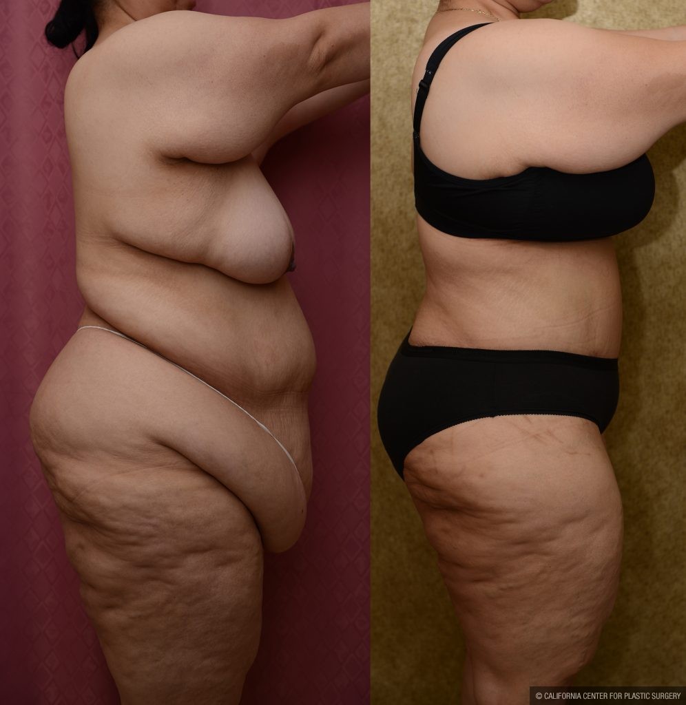 Tummy Tuck (Abdominoplasty) Plus Size Before & After Patient #11070